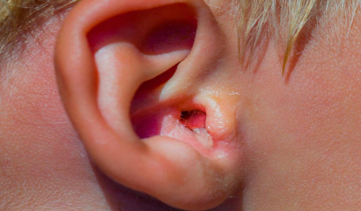 عفونت گوش خارجی کودکان