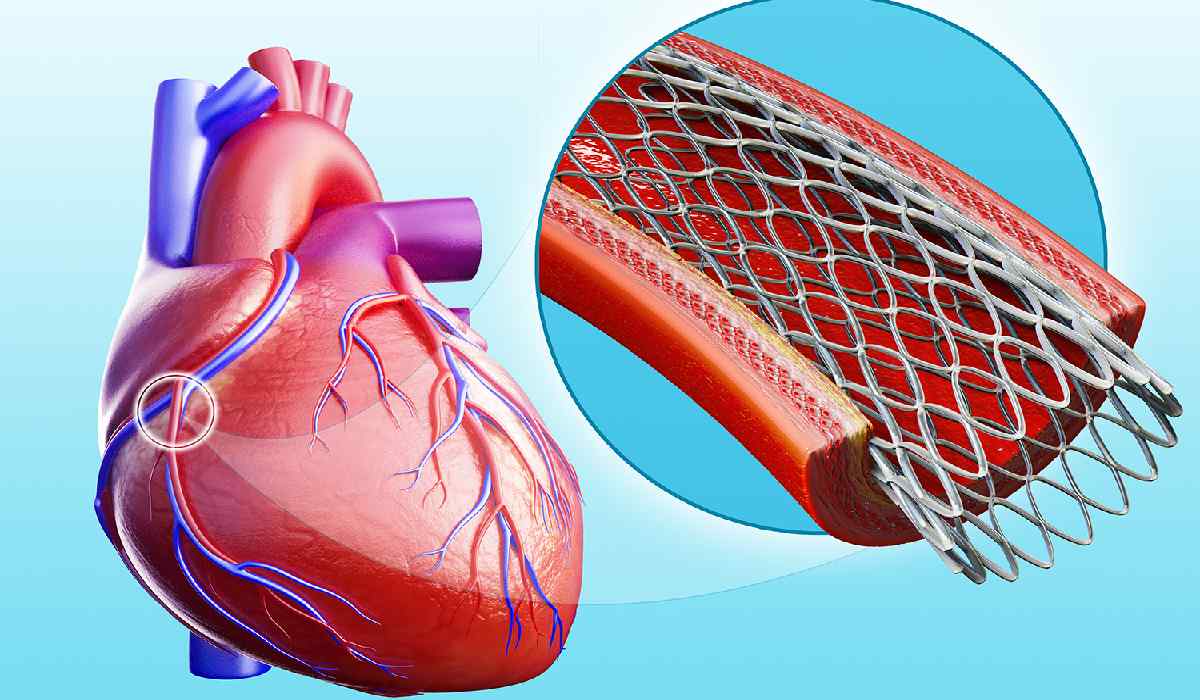 آنژیوپلاستی یا استنت گذاری، از روش های درمان گرفتگی عروق قلب