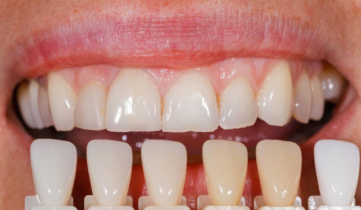 بهم ریختگی دندان باید با ارتودنسی درمان شود و با لمینت امکان اصلاح وجود ندارد.