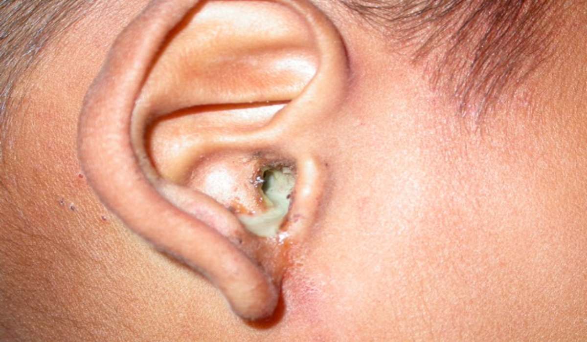 خروج عفونت از گوش کودک