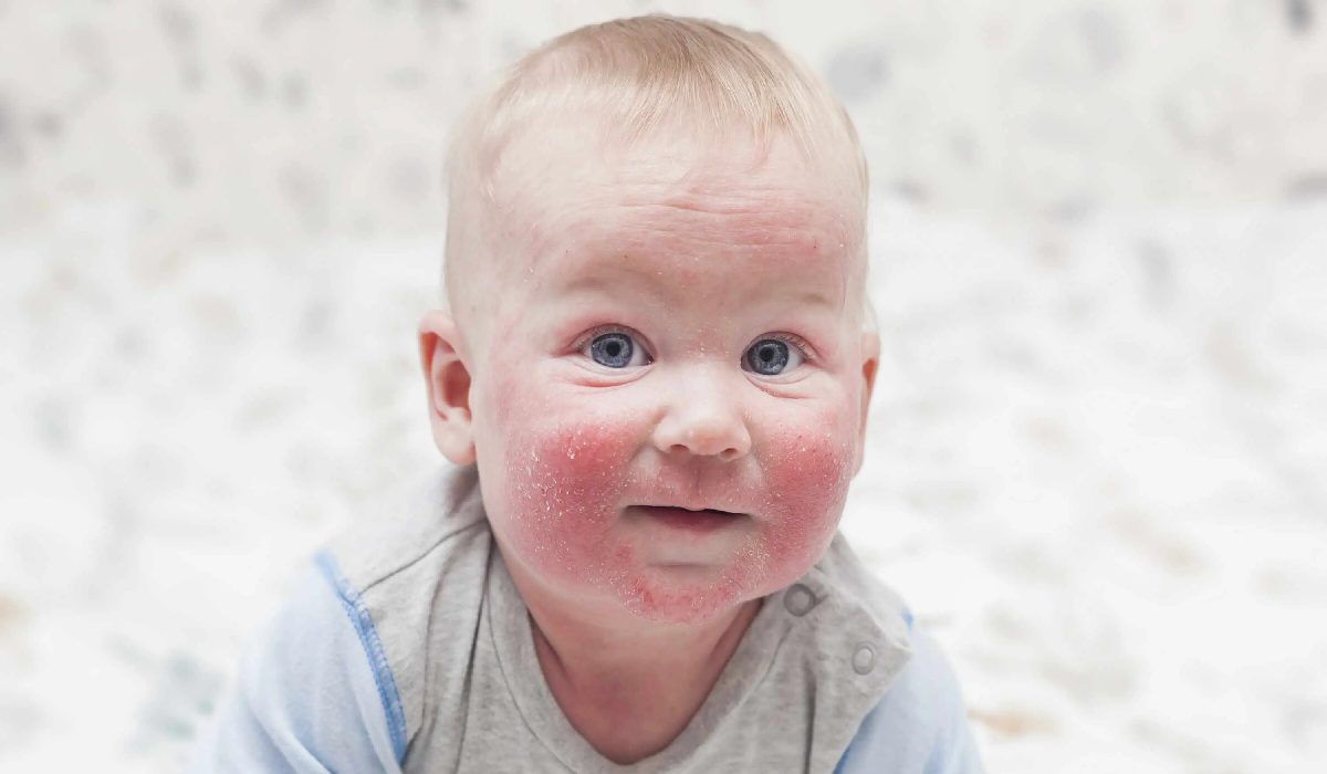 مشکل اگزما در نوزاد از علت های خشکی شدید در پوست نوازدان است