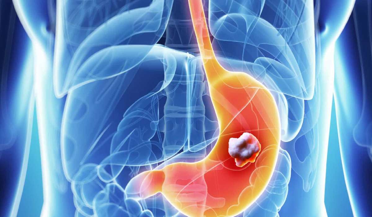 روش های درمان سرطان معده با دارو و جراحی