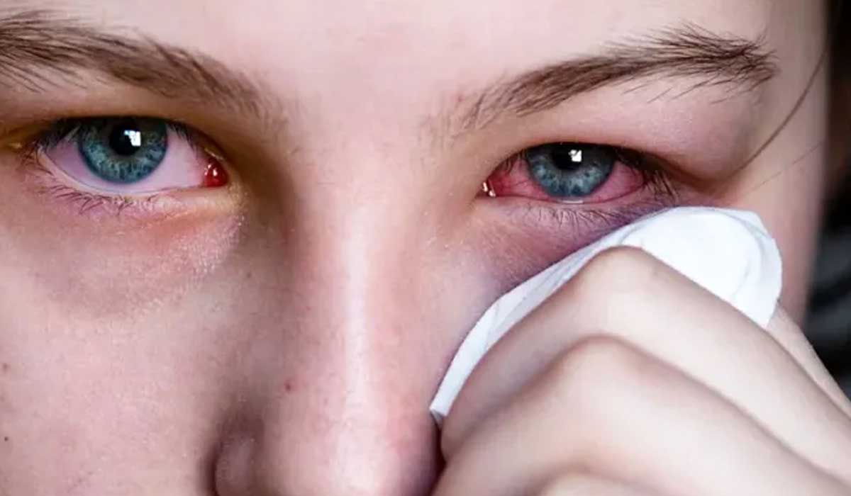 کنترل و درمان عفونت چشم