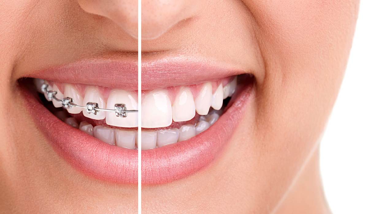 تفاوت لمینت دندان و ارتودنسی، کدام بهتر است؟