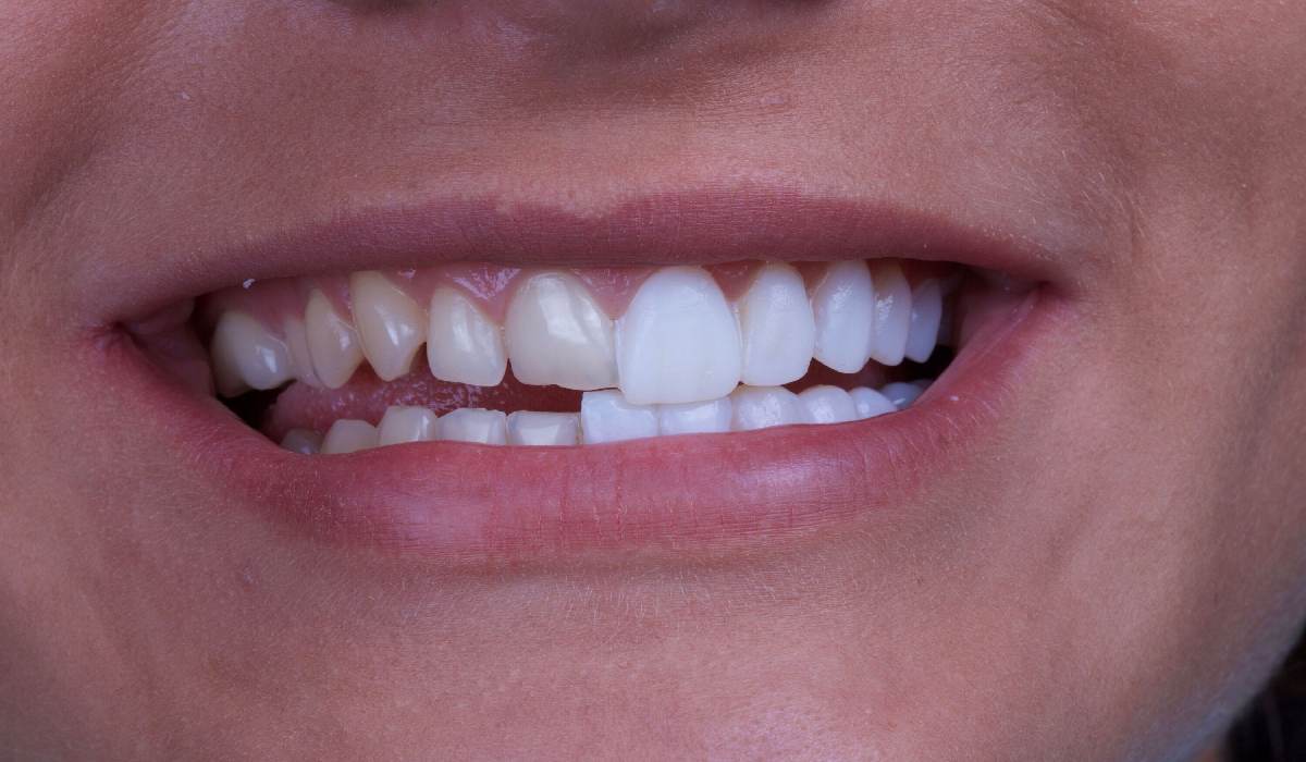 لمینت دندان برای ترمیم دندان های شکسته و زیبایی دندان مناسب است.