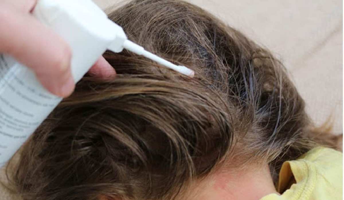 استفاده از محلول های شیمیایی برای درمان شپش مو و جلوگیری از گسترش آن