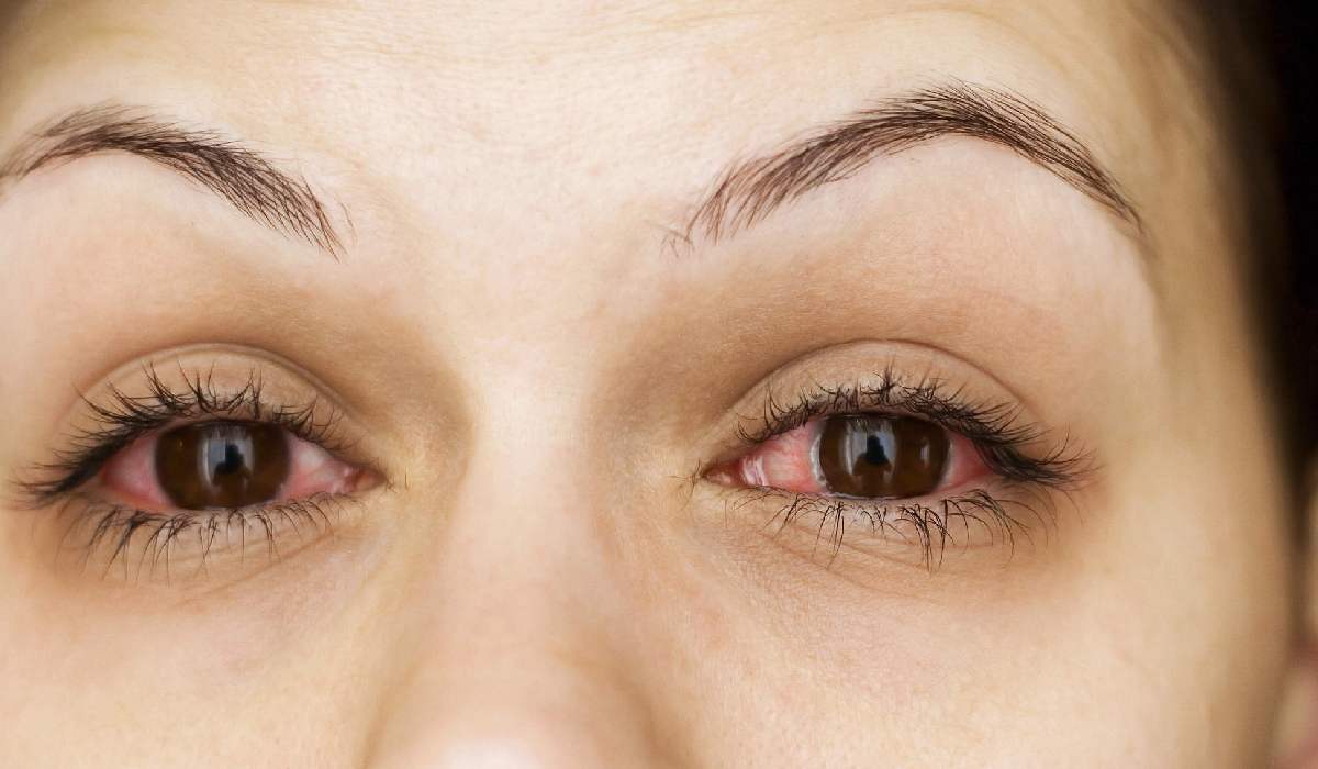 در فصل بهار، آلرژی و سرخ شدن چشم در افراد بیشتر مشاهده میی شود.