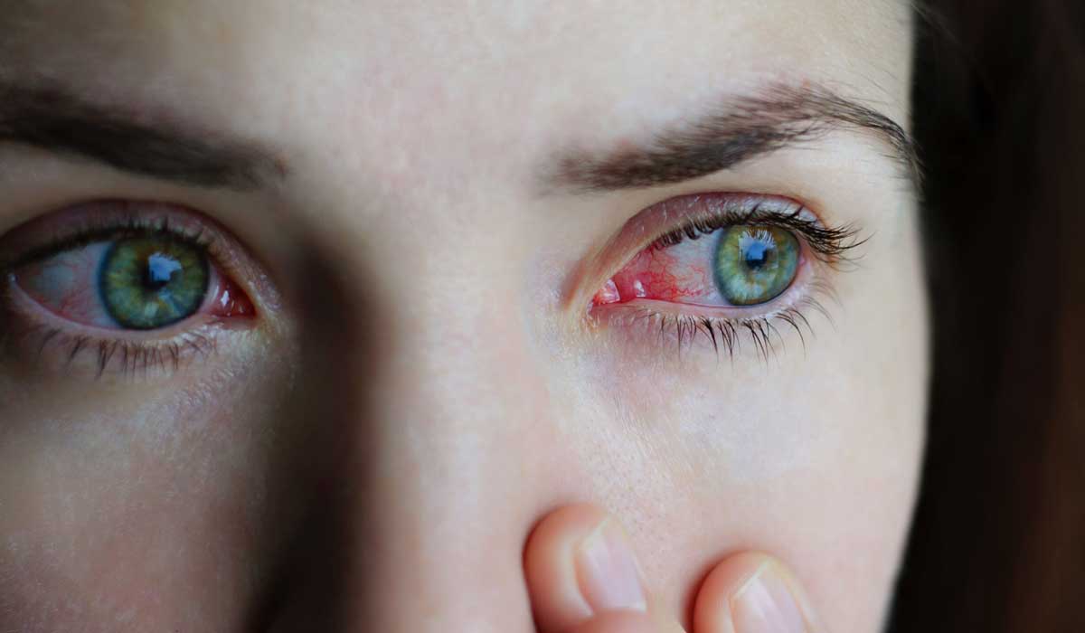 قرمزی در اثر عفونت چشم 