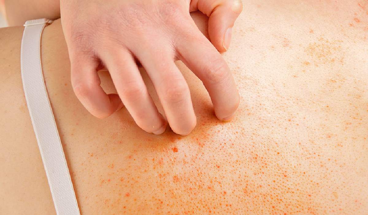 از بیماری های پوستی فصل بهار، خارش و قرمزی سطح پوست است.