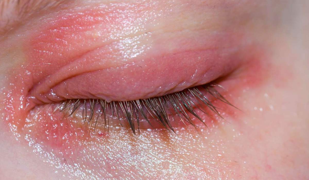 اثر التهابی پلک‌آماس یا بلفاریت روی پلک از علائم ابتلا به بیماری چشم
