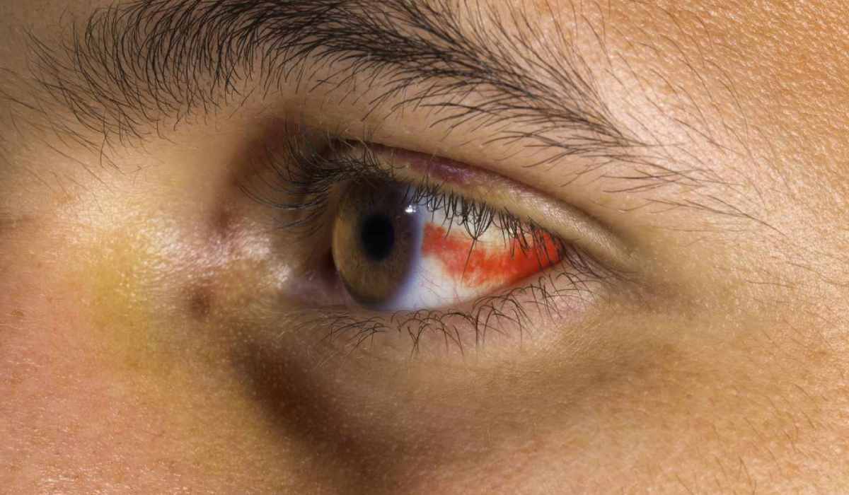 چشم درد خطرناک از علائم ابتدایی ابتلا به بیماری های چشمی