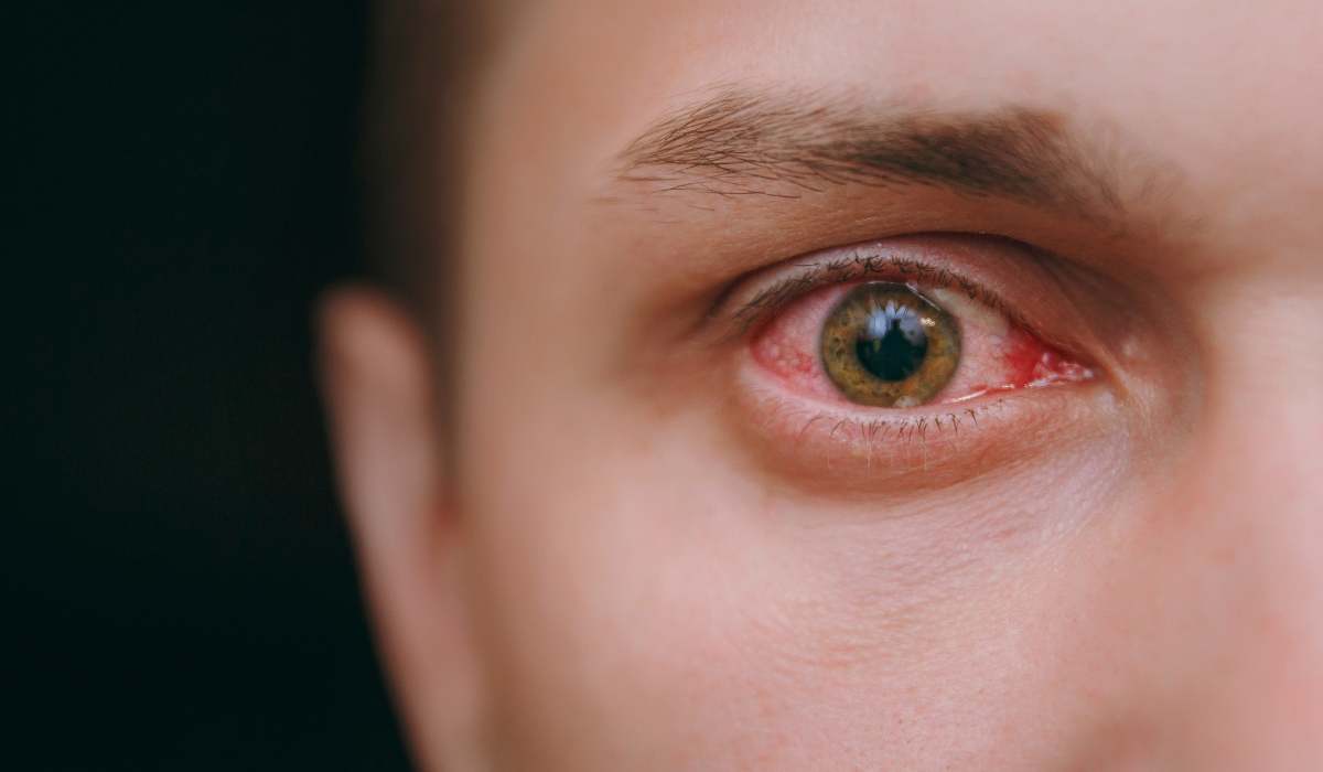تبخال چشمی از علائم ابتلا به بیماری چشمی