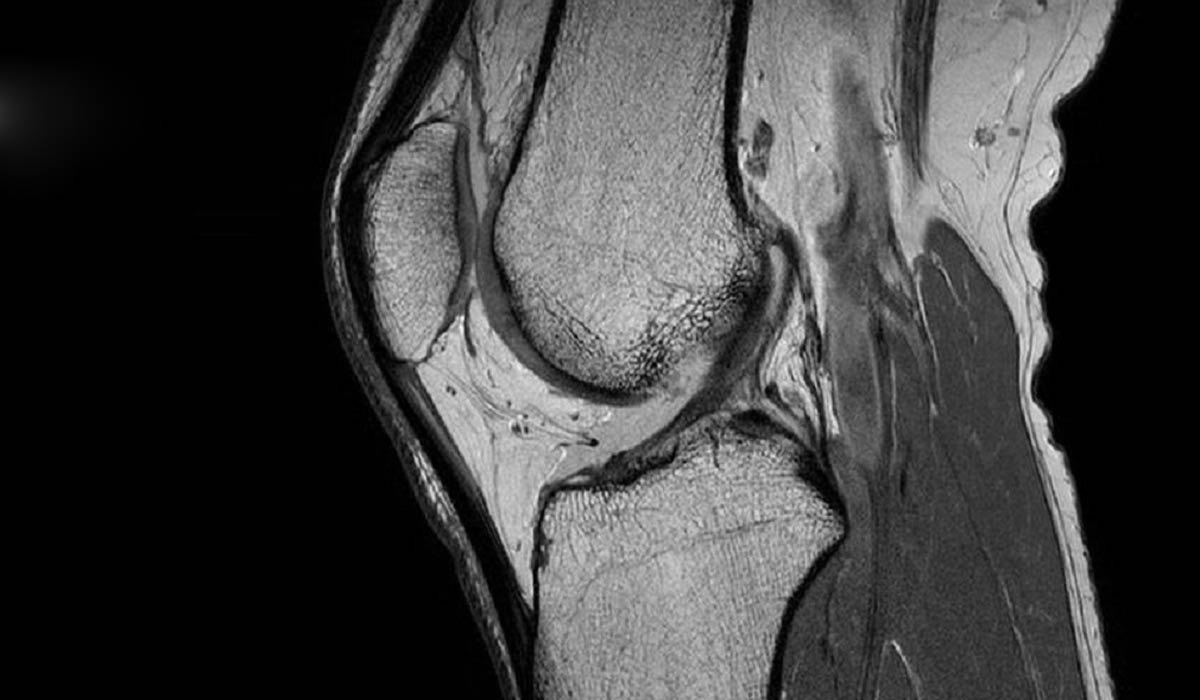 تصویر MRI برای تشخیص قفل کردن زانو