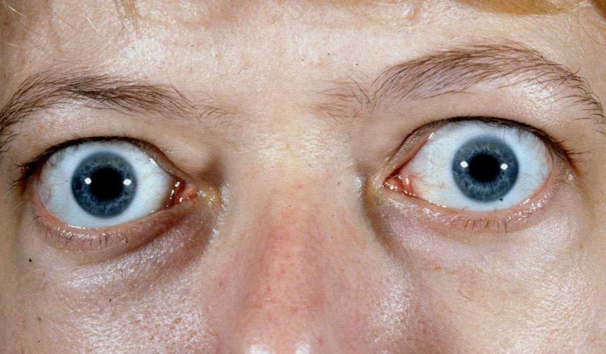 فردی با بیماری بیرون‌زدگی چشم از حدقه از علائم ابتلا به بیماری چشمی