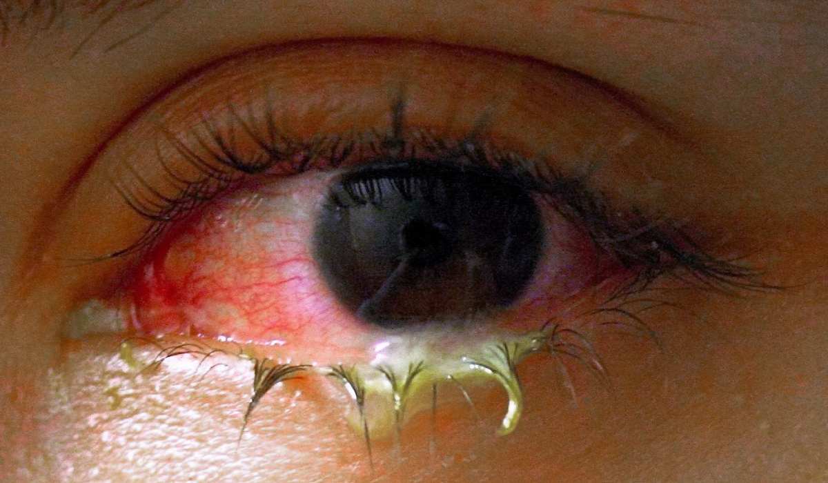 ورم ملتحمه یا بیماری چشم‌صورتی یکی از مهم ترین انواع بیماری های چشم است 