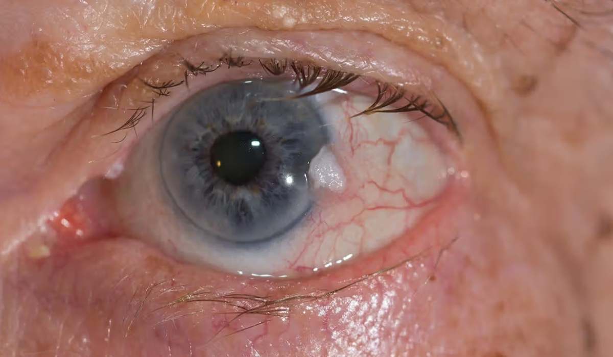 اثر سرطان چشم روی قرنیه یکی از انواع بیماری های چشمی است
