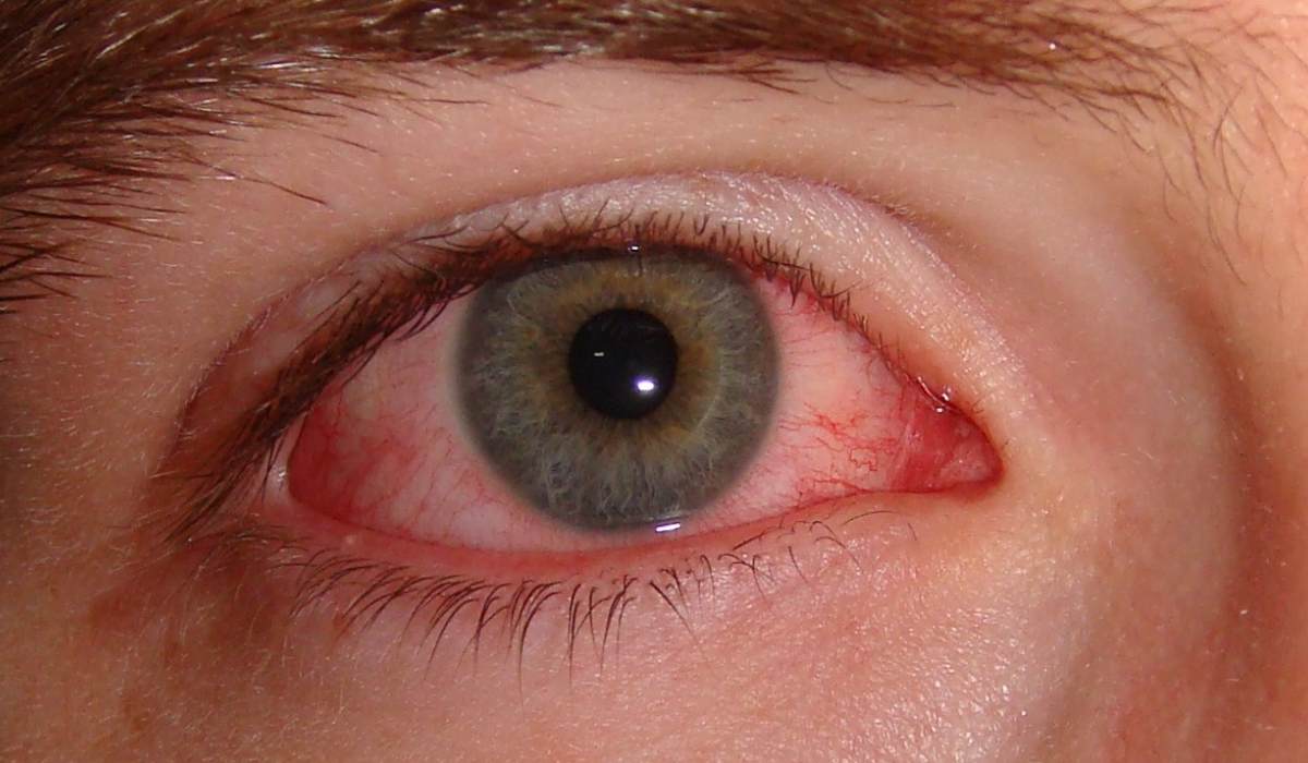 علائم سندروم چشم قرمز یا قرمزی چشم یکی از علت های ابتلا به بیماری های چشمی است