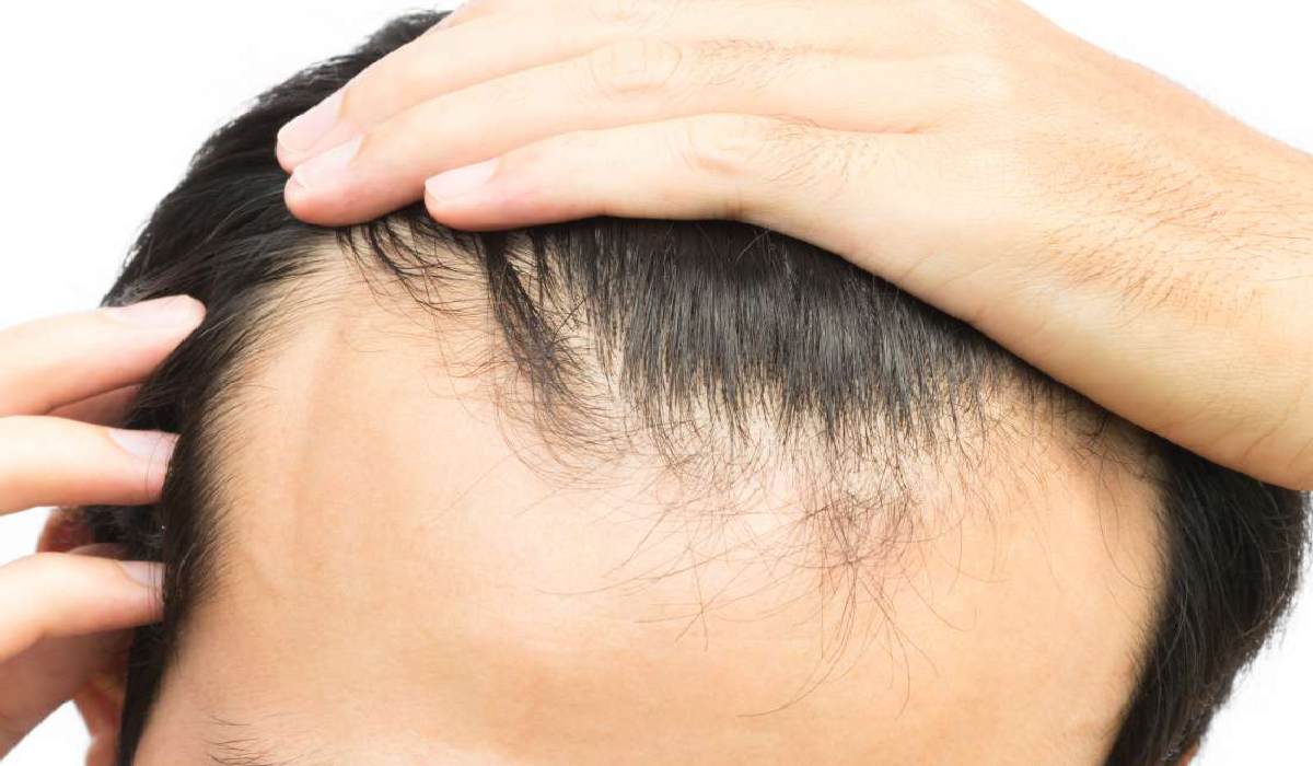 استفاده از دارو و مواد تقویتی برای افزایش سرعت رشد موی سر