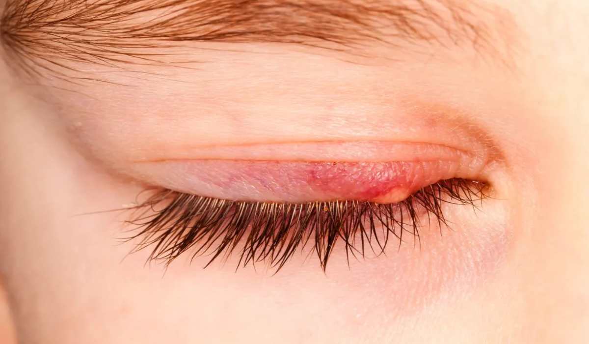 اثر گل مژه روی چشم یکی از علائم بیماری های چشم است