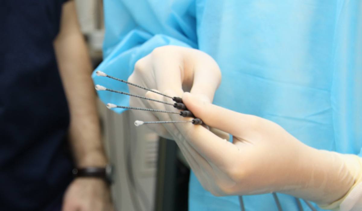 اوتوروسکوپی از عمل های جراحی برداشتن سنگ کلیه