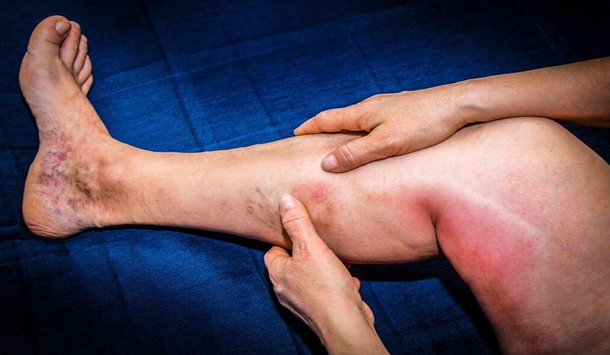 علت درد ساق پا به علت سندروم بیش‌حرکتی مفاصل