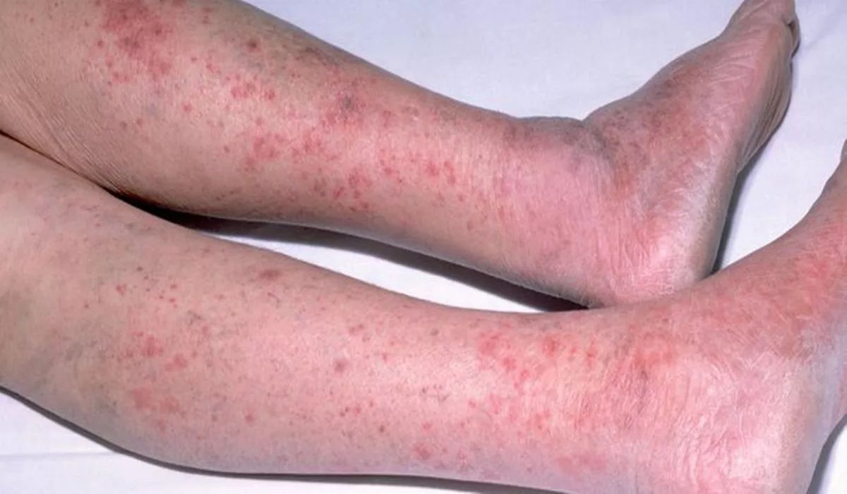 ظهور بثورات پوستی از علائم بیماری مننژیت