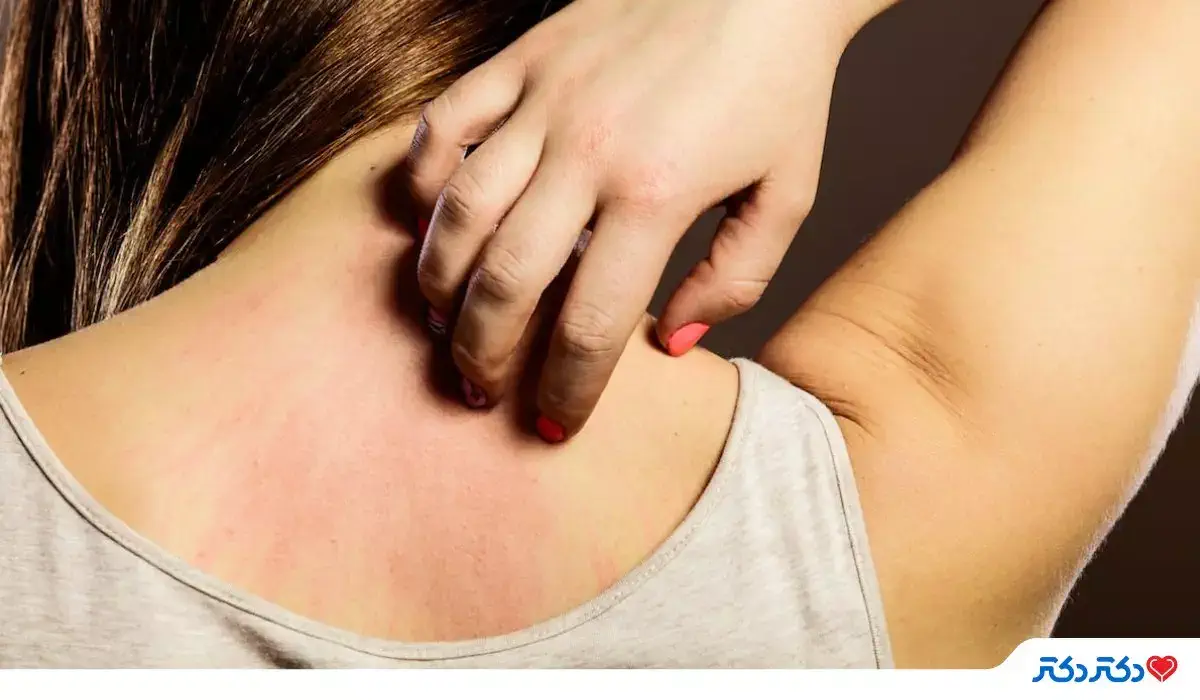 بثورات حرارتی یکی از مشکلات پوست رایج در بدن