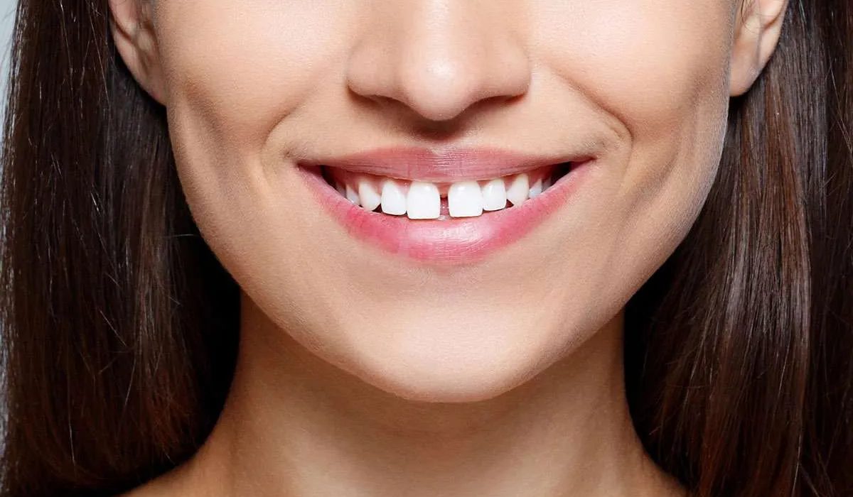 مزایای کامپوزیت دندان برای پر کردن فاصله دندان‌ها