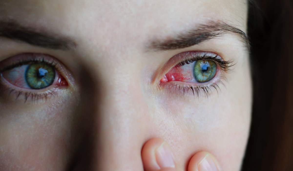 درمان عفونت چشم در سرماخوردگی با آثار قرمزی و خشکی چشم