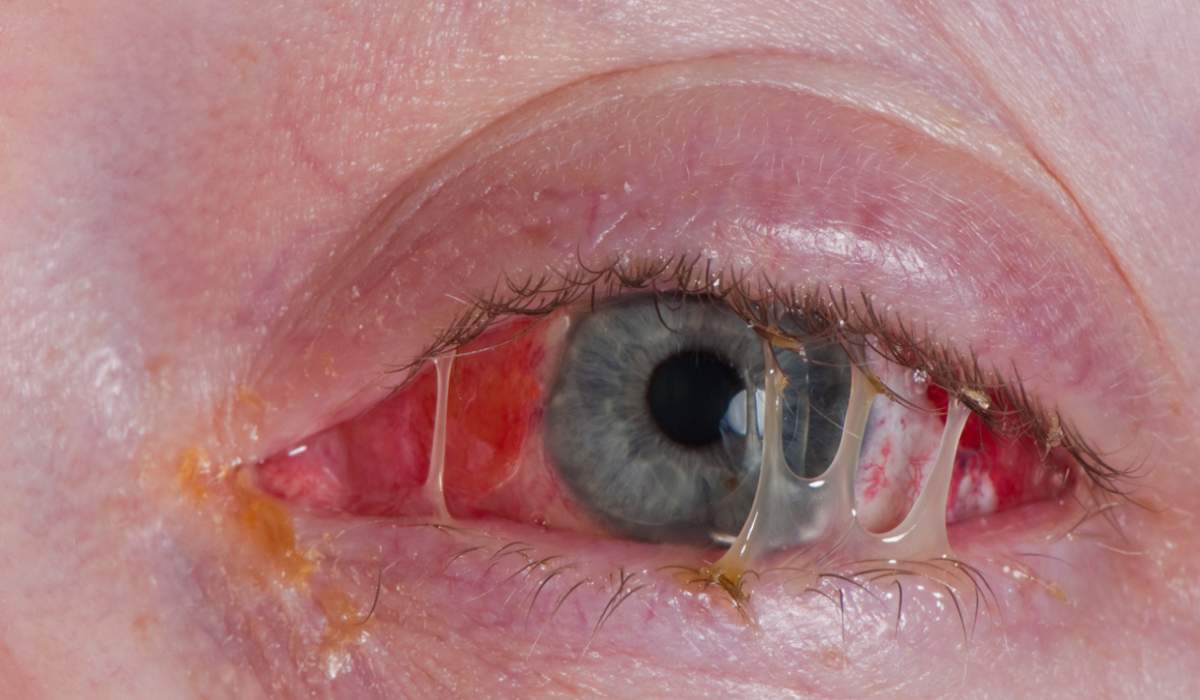 درمان عفونت چشمی میکروبی