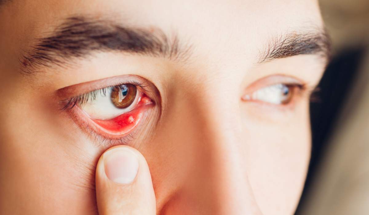 گل مژه یکی از انواع عفونت چشم