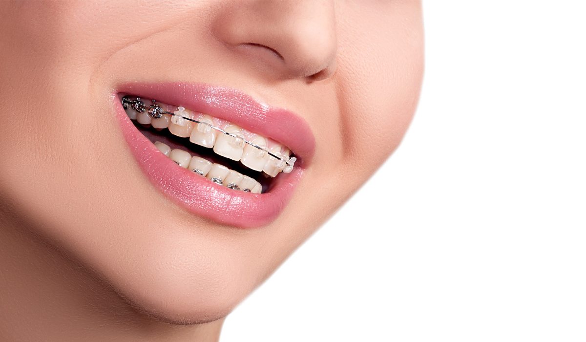 ارتودنسی دندان روشی برای همسان‌سازی دندان‌ها