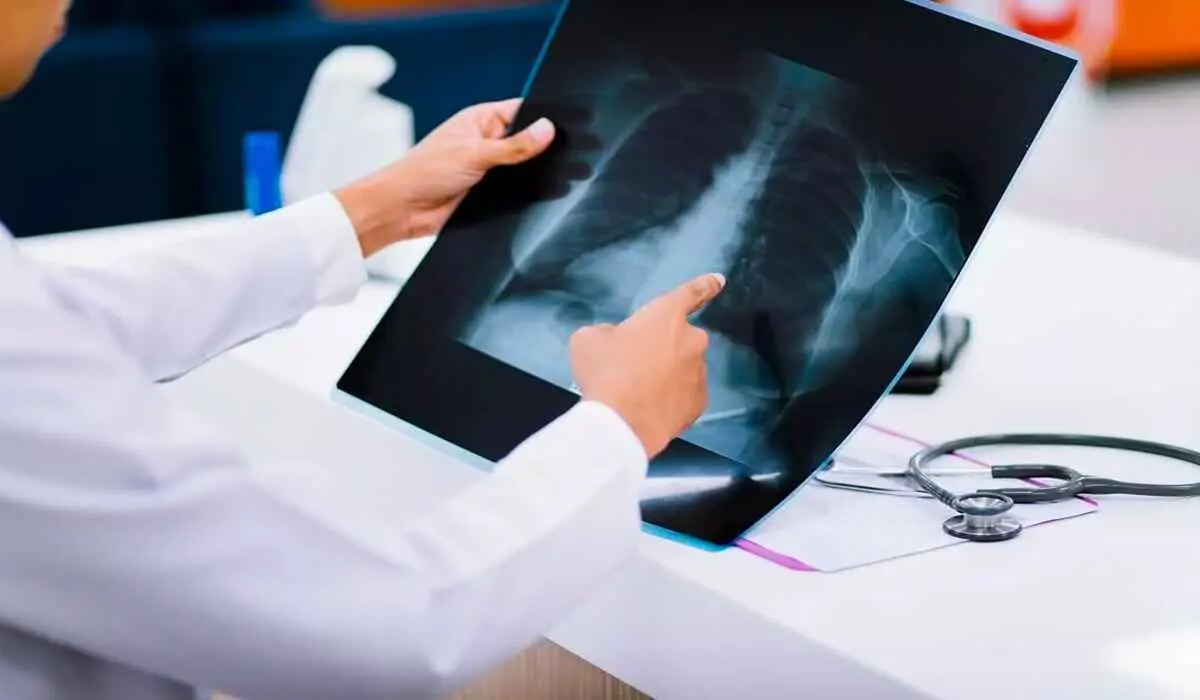 استفاده از اشعه ایکس یا X-ray برای تشخیص شکستگی دنده