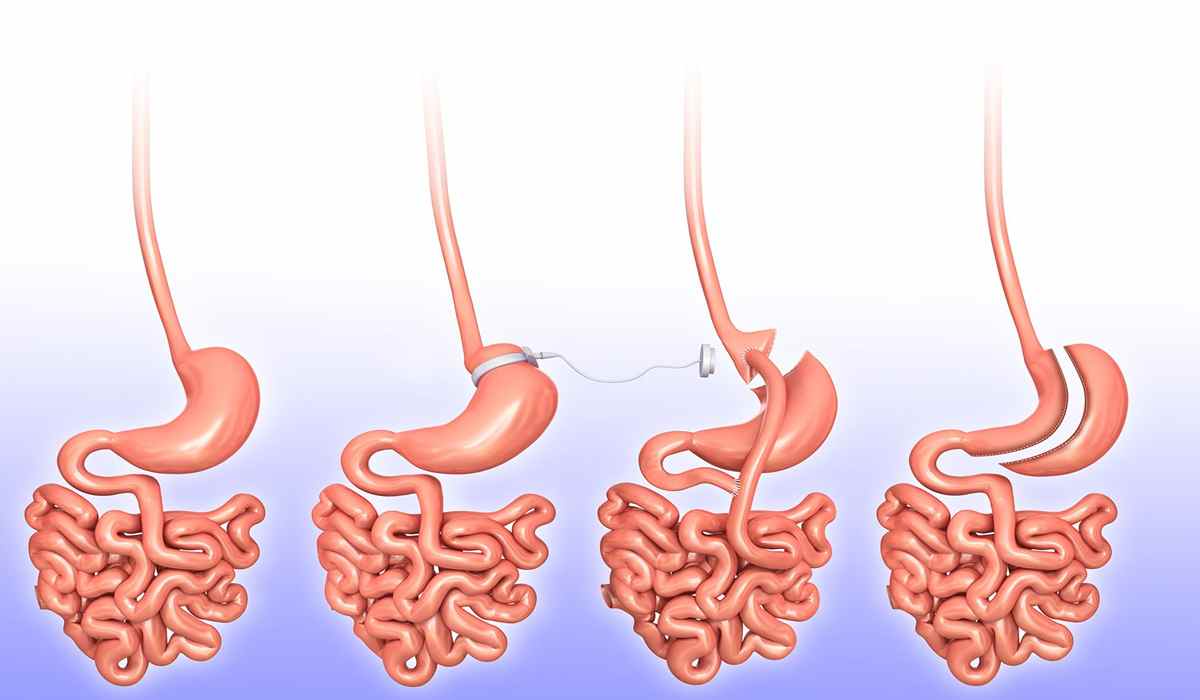 درمان لاغری با روش عمل بای پس معده