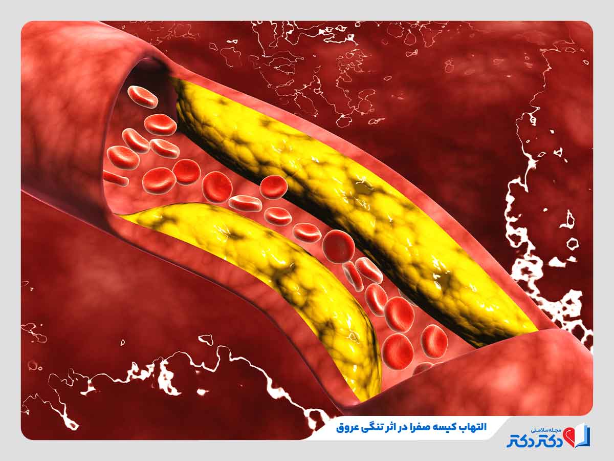 کاهش جریان خون به کیسه صفرا در اثر گرفتگی عروق و ابتلا به التهاب کیسه صفرا