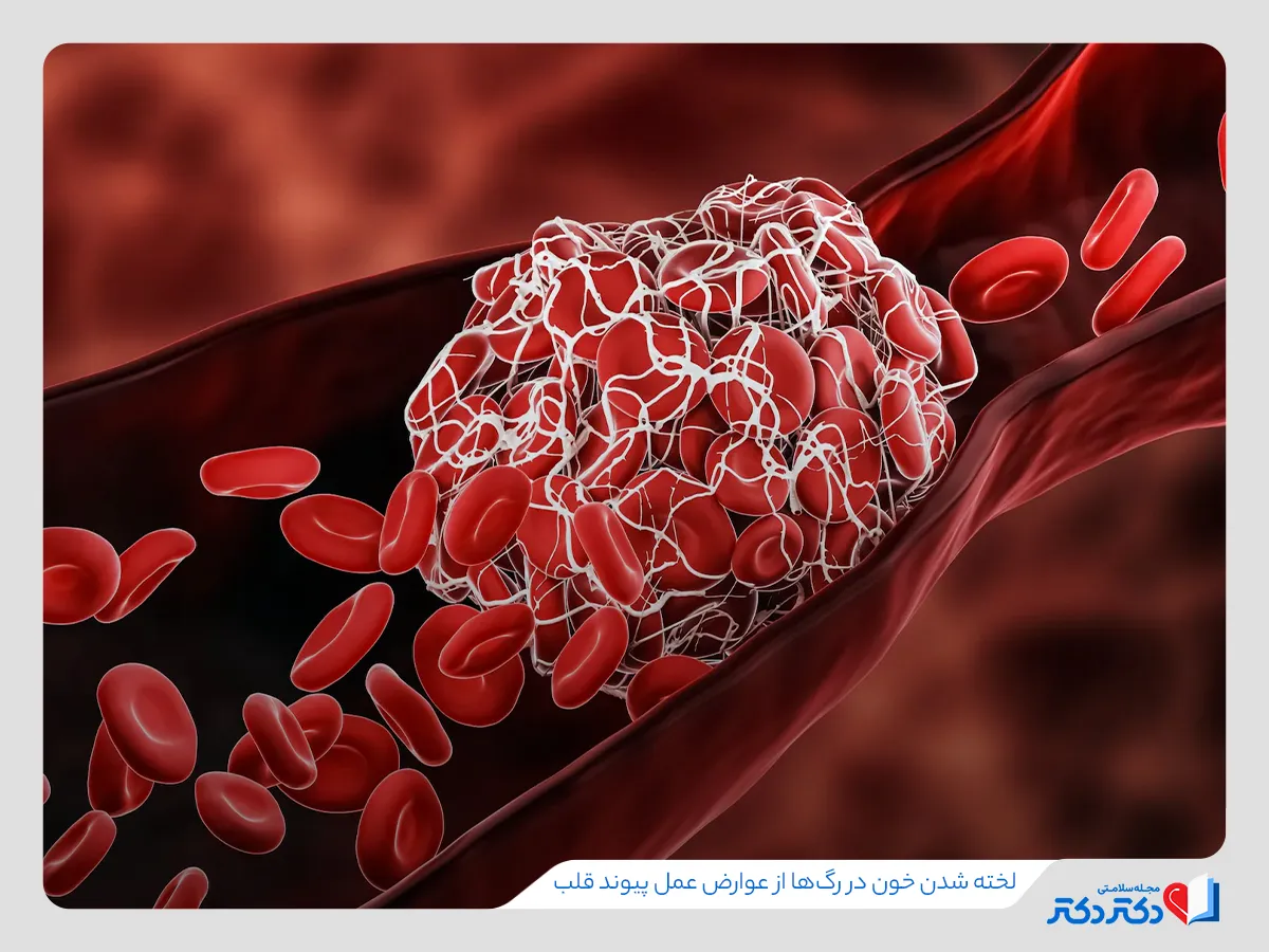 لخته شدن خون در رگ ها از عوارض عمل پیوند قلب