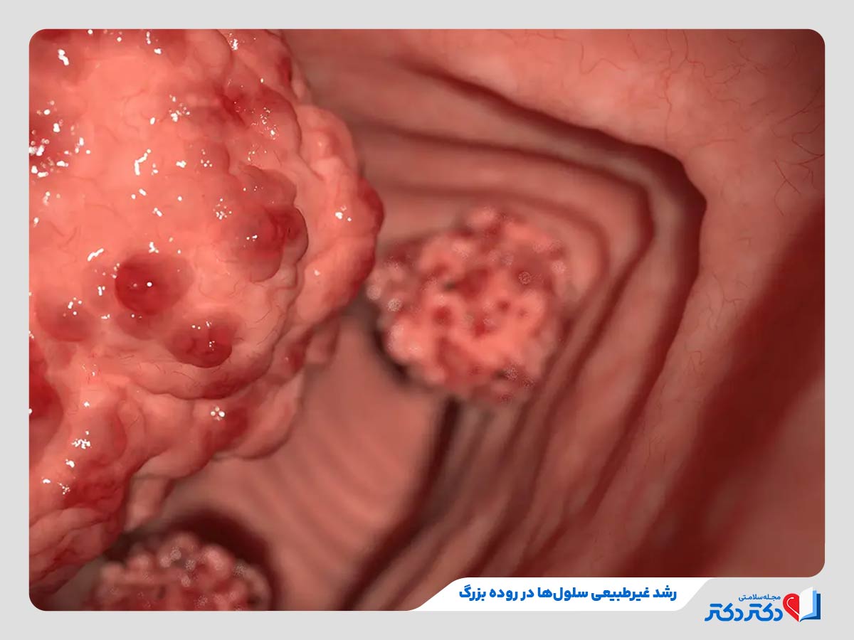 تبدیل پولیپ‌های غیرسرطانی به سلول‌های سرطانی در سرطان روده بزرگ