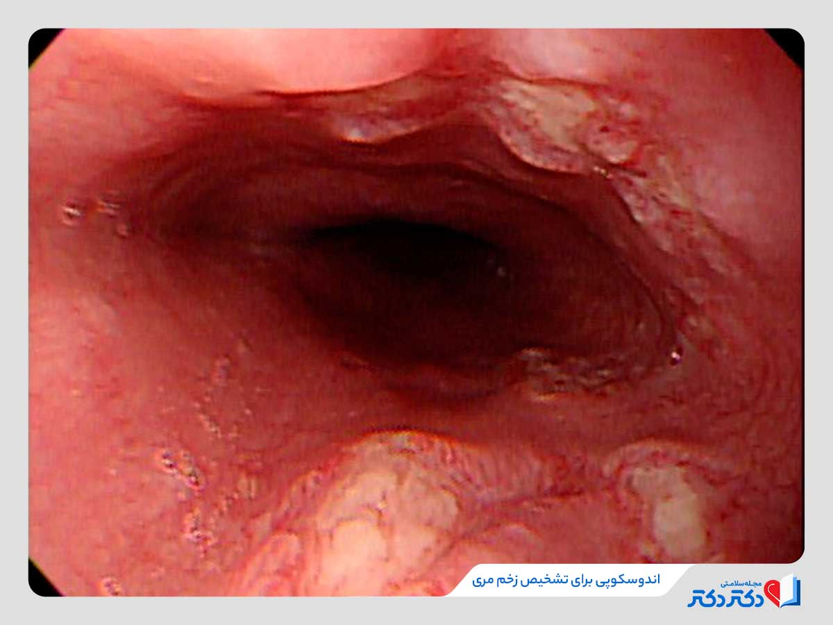 اندوسکوپی یکی از روش‌های تشخیص زخم مری 