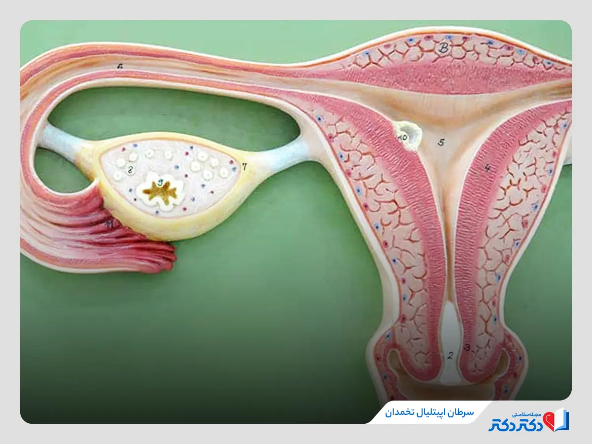 سلول زایای تخمدان از اصلی‌ترین دلایل ایجاد سرطان اپیتلیال تخمدان 