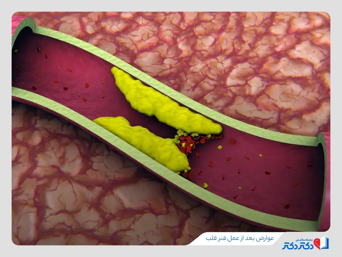 تصویر نشان دهنده گرفتگی رگ قلب از عوارض بعد از عمل فنر قلب