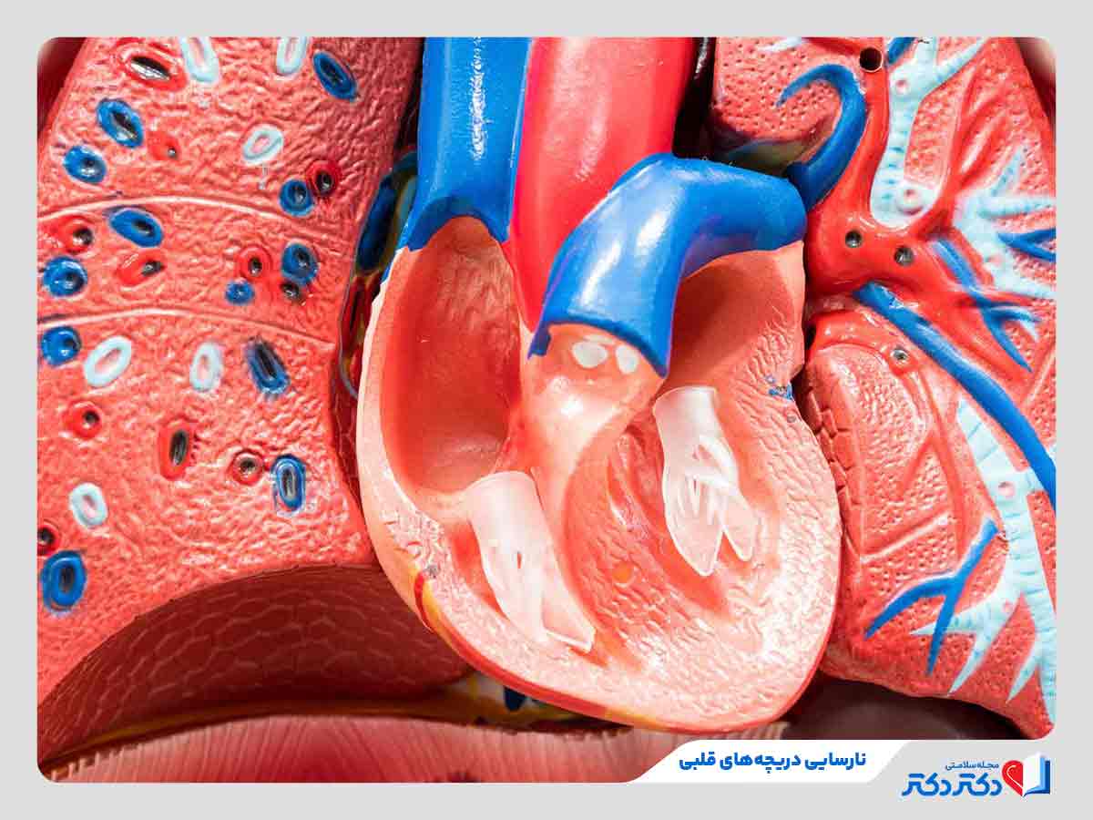 قلب درد ناشی از نارسایی دریچه قلب