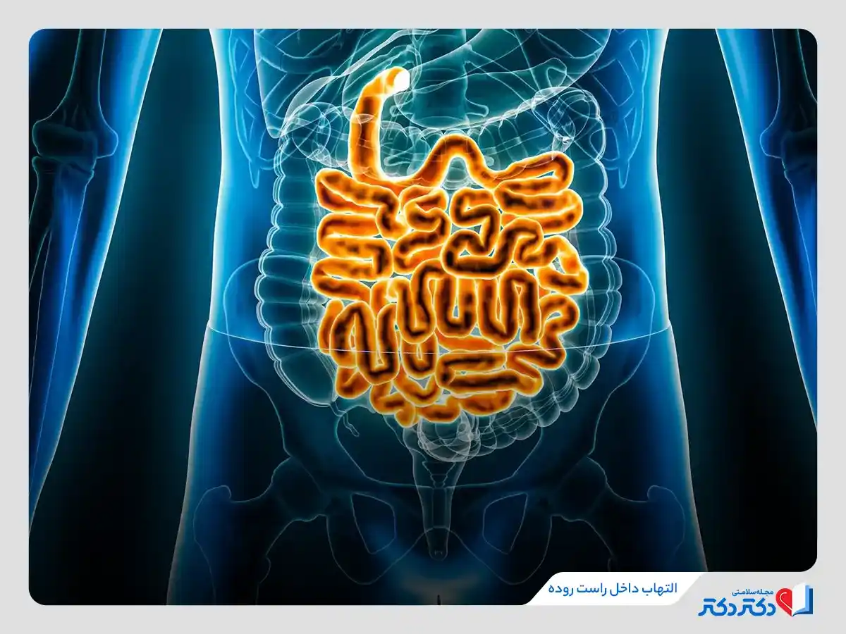 التهاب داخل راست روده از عوامل بروز بیماری پروکتیت 