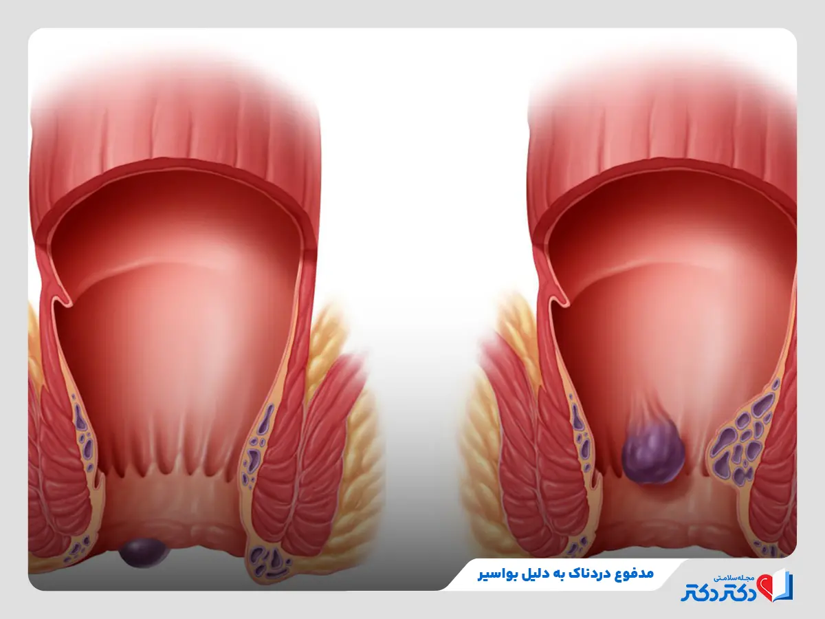 بیرون زدگی مقعد یا همروئید و درد هنگام دفع