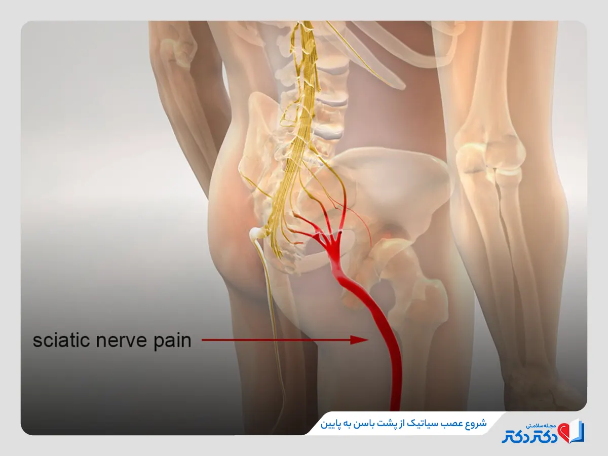 یکی از نکات اصلی شروع درد سیاتیک