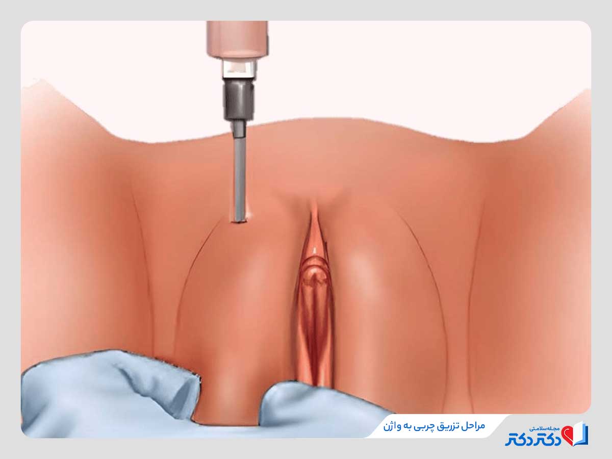 مراحل تزریق چربی به واژن 