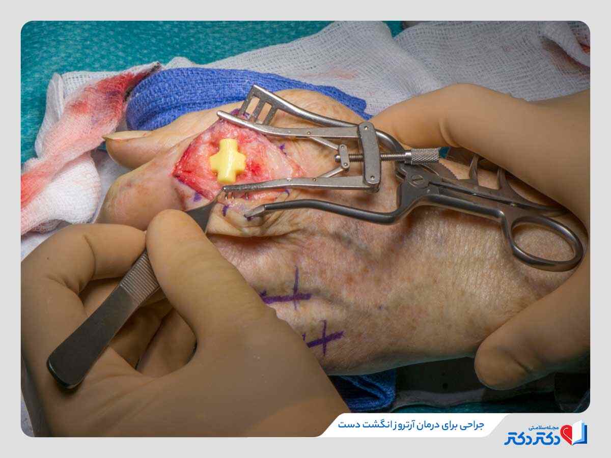 جراحی برای درمان آرتروز انگشت دست