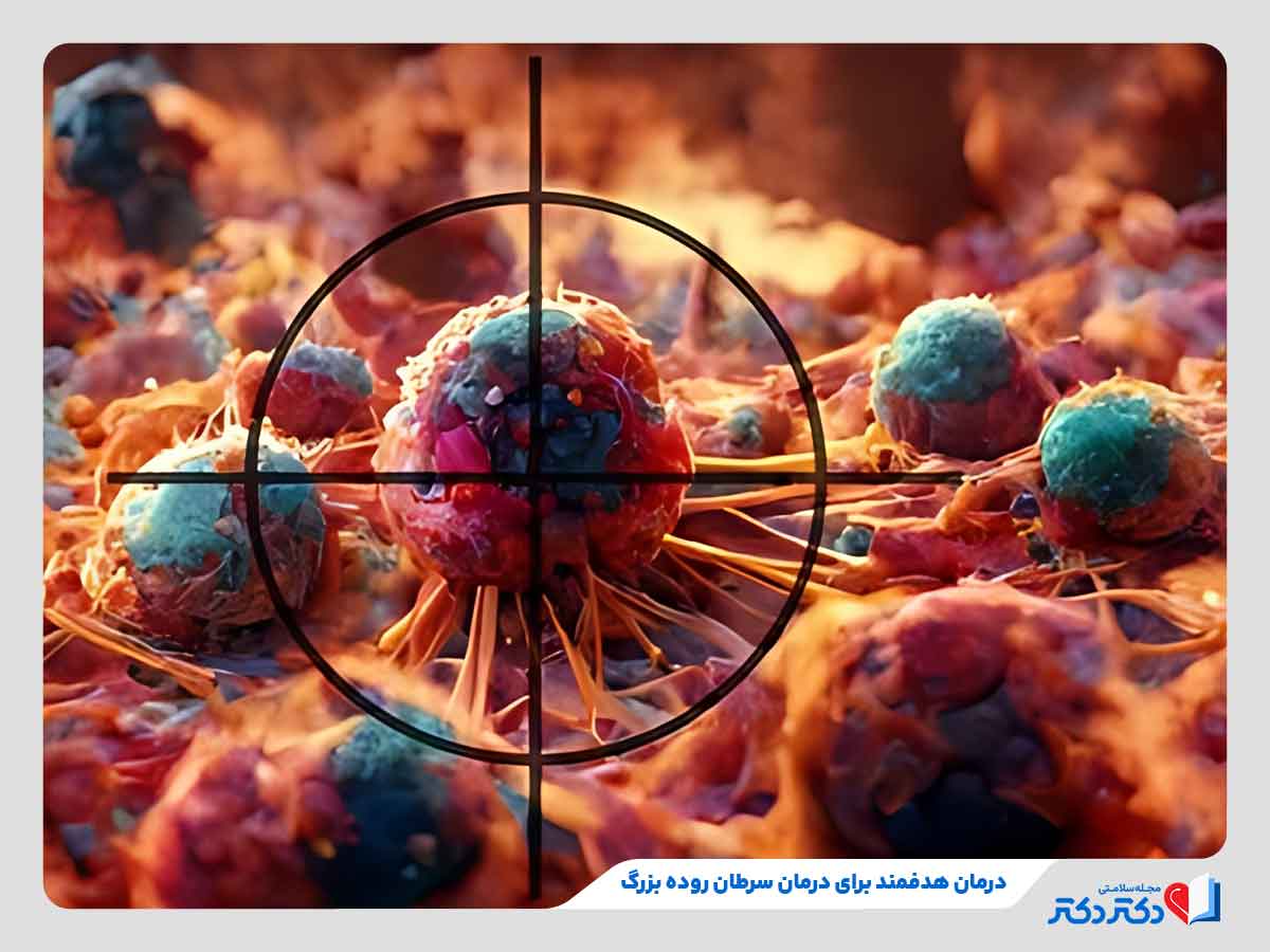 هدف قرار دادن سلول‌های سرطانی برای درمان سرطان روده بزرگ