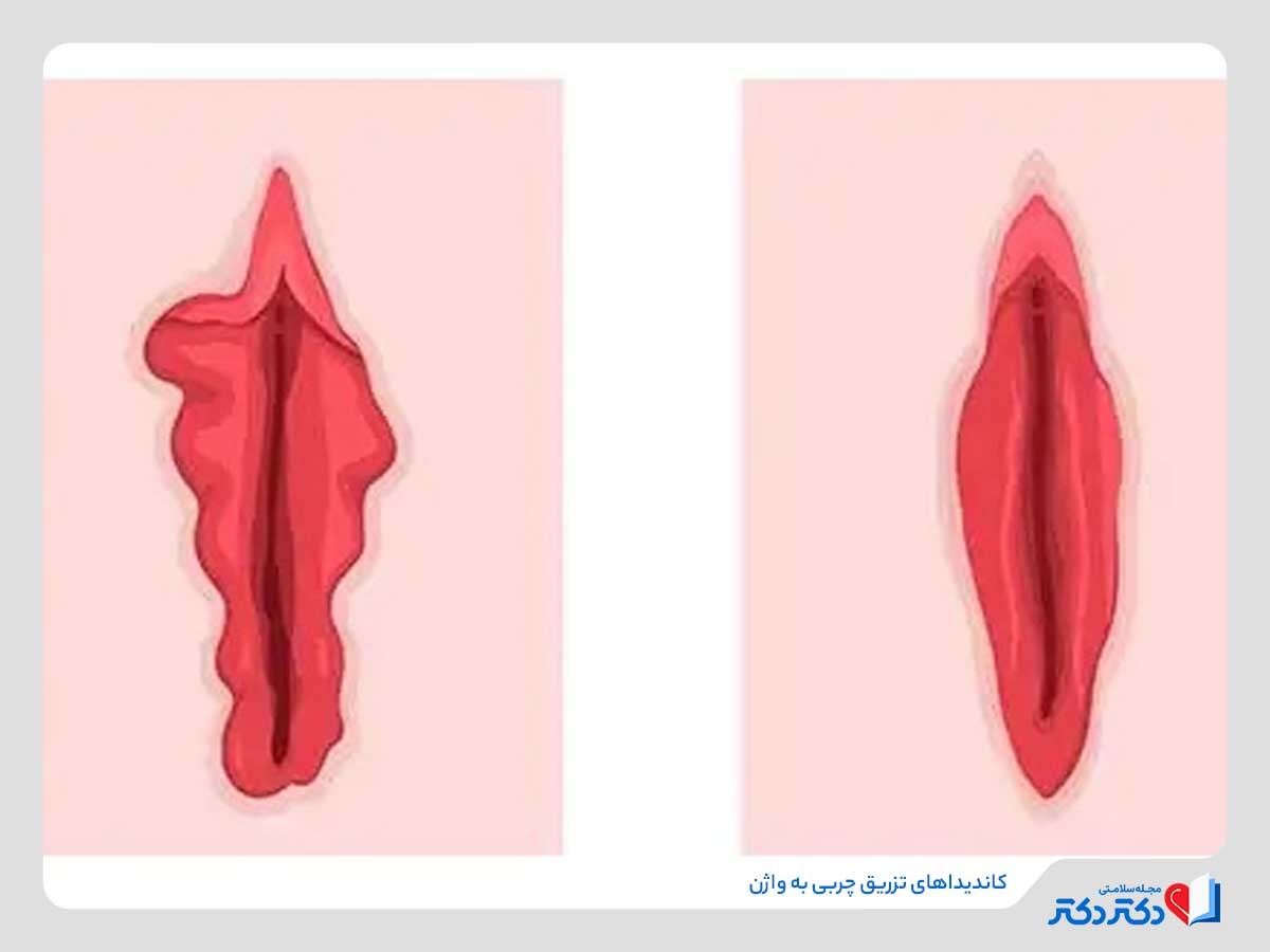 افراد مناسب برای تزریق چربی به واژن