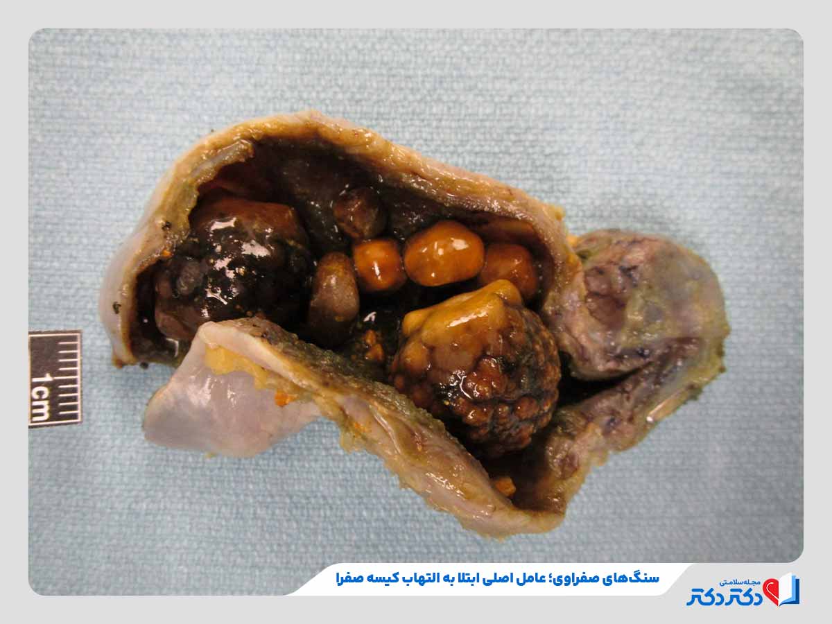 ابتلا به التهاب کیسه صفرا ناشی از سنگ‌های صفراوی