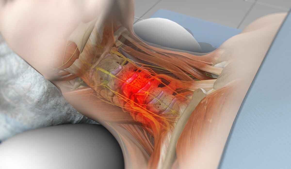 برداشتن بخشی از دیسک بین مهره‌ای جهت کاهش فشار روی نخاع و عصب گردن